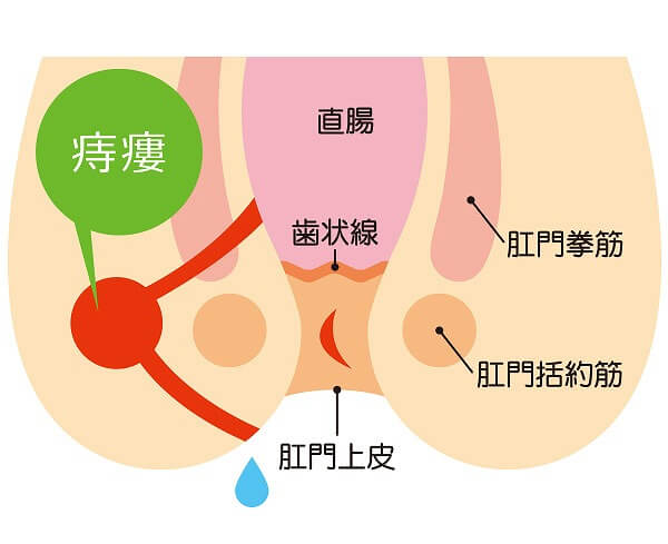 痔ろう(穴痔）と肛門周囲膿瘍